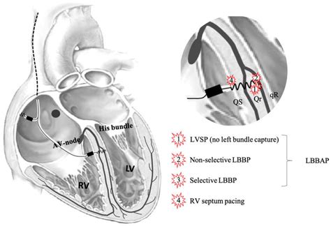 lv only pacing|left bundle branch area pacing.